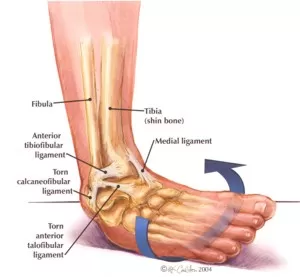 Ankle Sprain? Here is all you need to know!