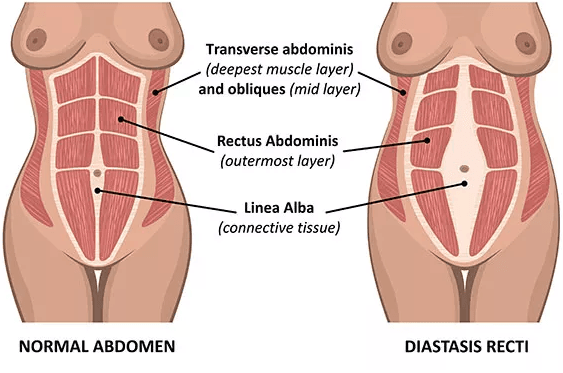 Diastasis Recti Treatment Mississauga Pelvic Health