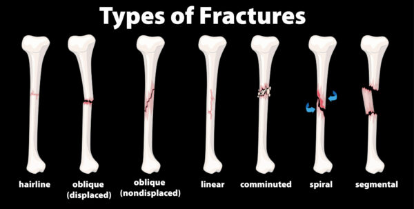 Treatment for fractures Toronto
