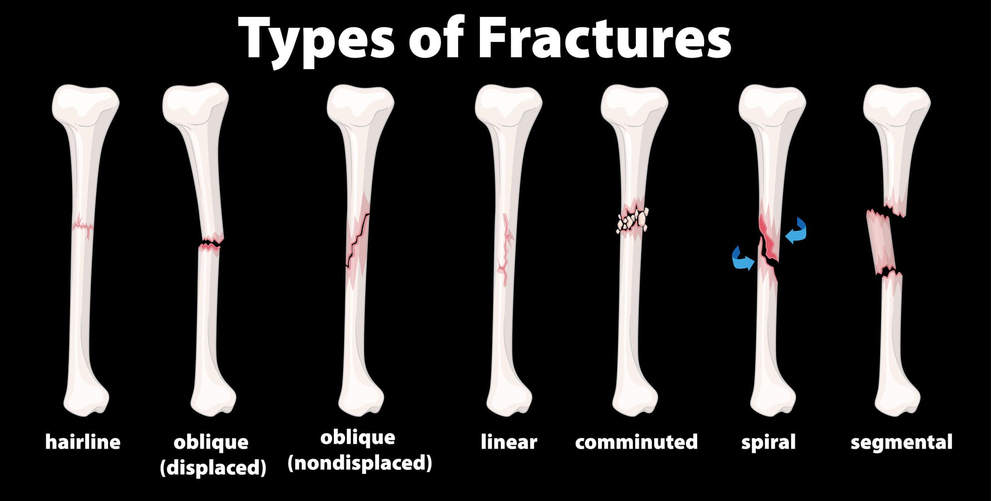 Fracture Treatment Toronto
