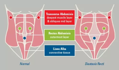 Diastasis Recti Abdominus – Separation of the Abdominal Muscles