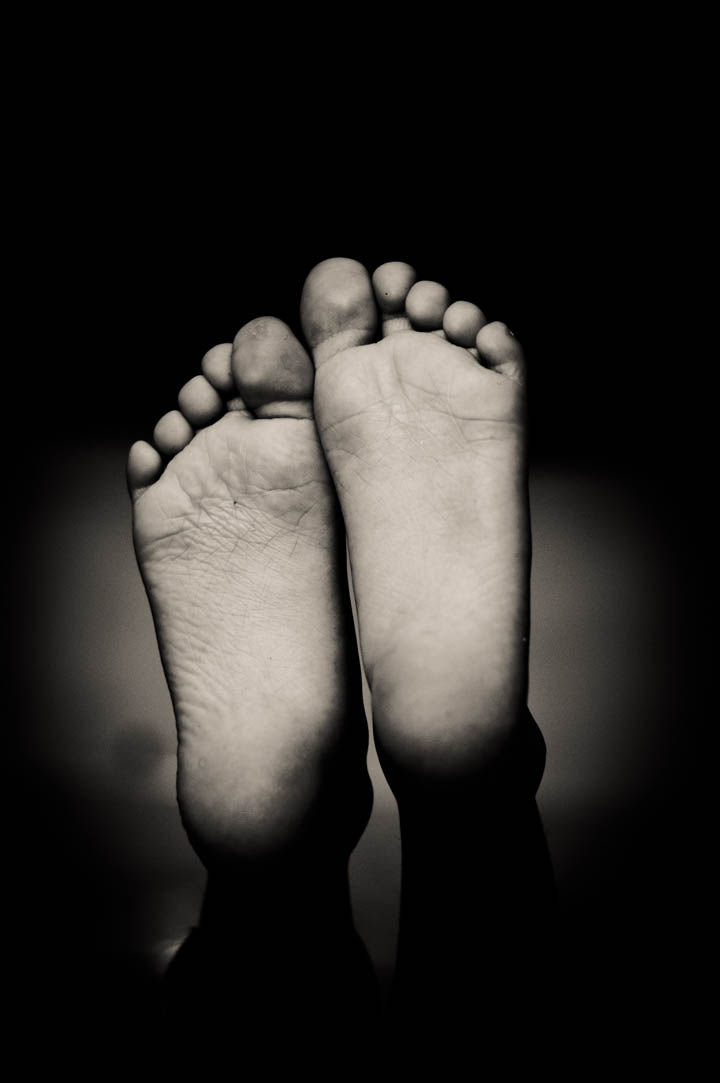 Can a Physiotherapist Help with Plantar Fasciitis?