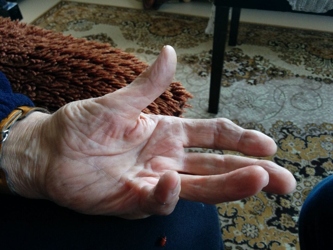 Dupuytren’s Contracture