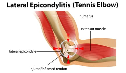 Tennis Elbow (Lateral Epicondylitis)