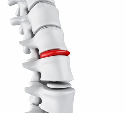 Disc Herniation