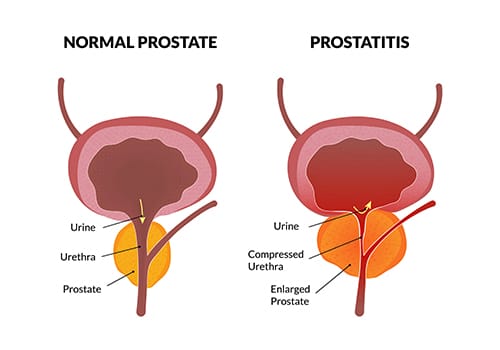 Chronic Prostatitis Treatment