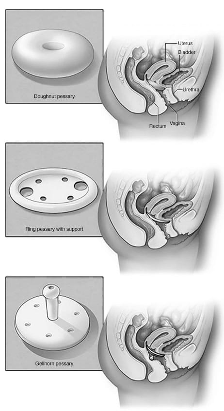 Pelvic Organ Prolapse Triangle Physiotherapy 