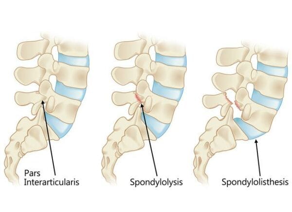 Spondylolisthesis Physiotherapy Mississauga