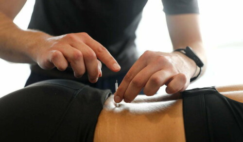 Dry Needling vs. Acupuncture: Which Is Right for You?