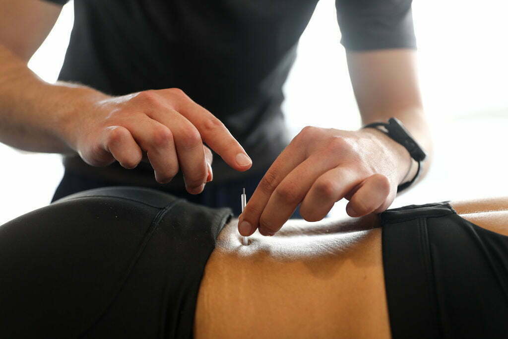 Dry Needling vs. Acupuncture: Which Is Right for You?