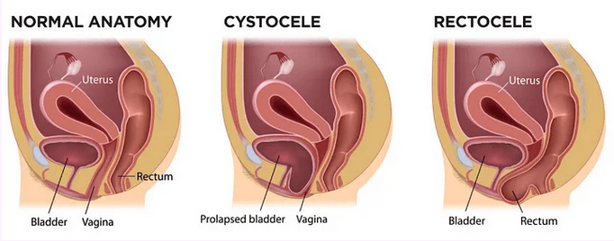 Mississauga Pelvic Helath