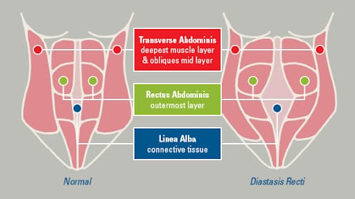 Rectus Diastasis