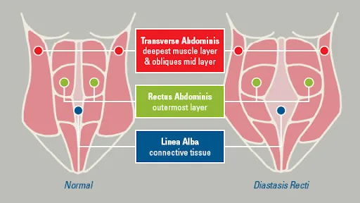 Rectus Diastasis