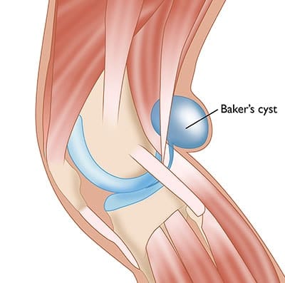 Baker’s Cyst