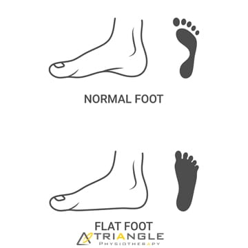 Flat Feet - Triangle Physiotherapy