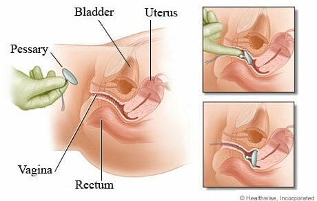 Can a Pessary Help with Pelvic Organ Prolapse?