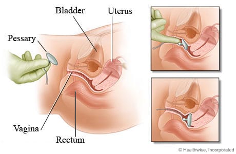 Can a Pessary Help with Pelvic Organ Prolapse?