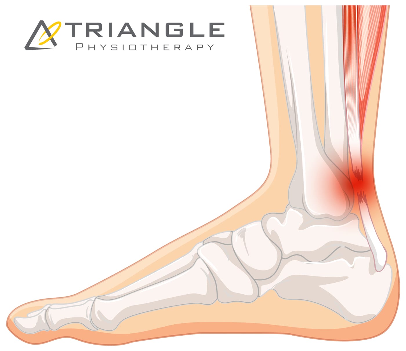 Achilles Tendonitis - Get Podiatry Treatment In Memphis Or Torrance |  Renuva Xtremity