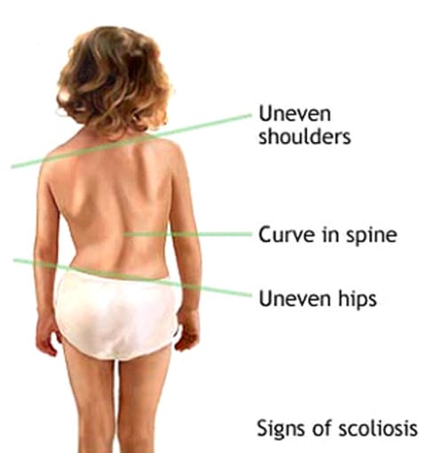 Physiotherapy for Scoliosis