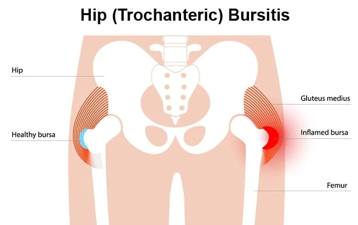 Trochanteric Bursitis