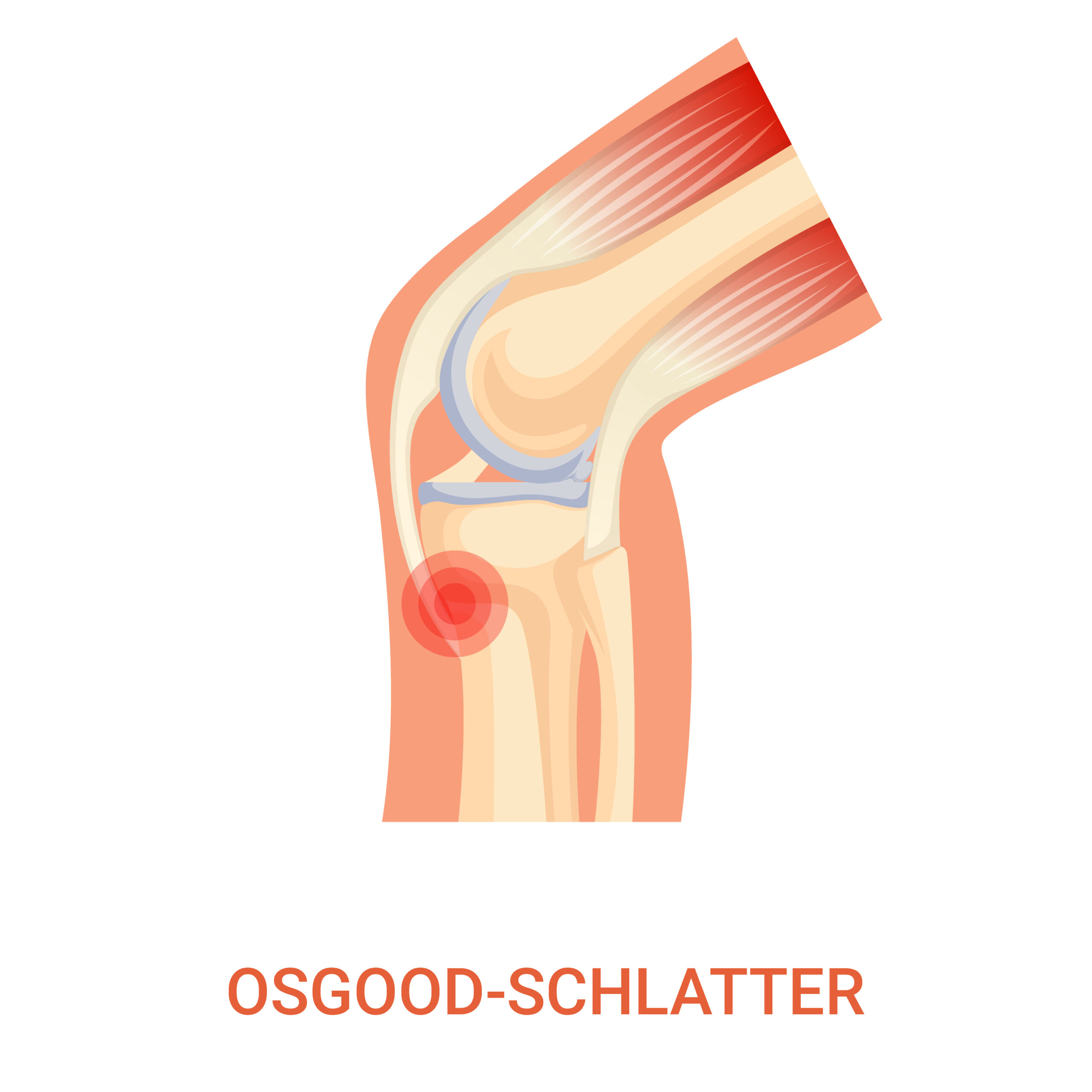 Osgood Schlatter’s Disease