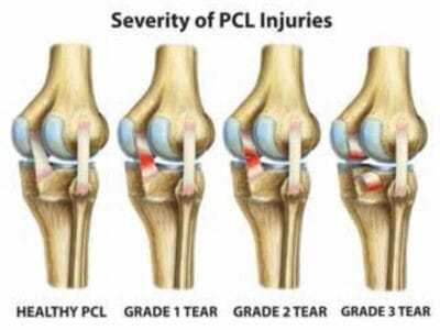 PCL Injury