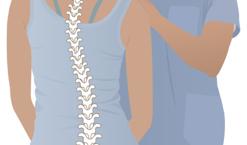 Can Physiotherapy Help with Scoliosis?