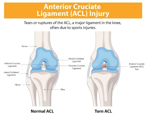 ACL Tear Etobicoke