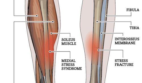 Tibial Stress Fractures in Runners